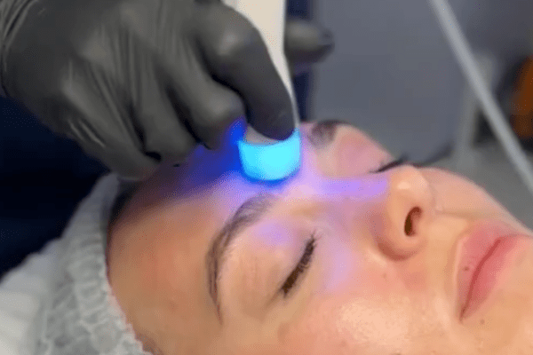 Hydra Facial
